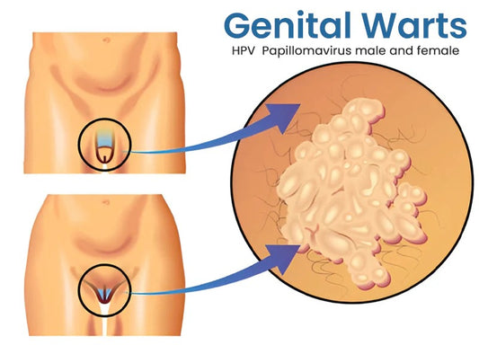 Herbal Genital Skin Treatment Cream✅ Revolutionary Natural Solution for Genital Wart Treatment!